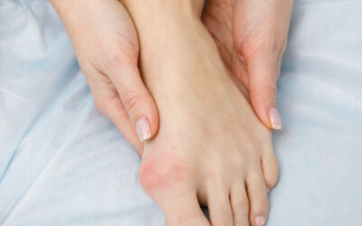 Hallux valgus, épine calcanéenne et syndrome de Morton